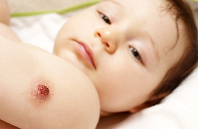 Cepljenje v ramo novorojenčkov od česa.  Nega otroka po cepljenju.  Kdaj BCG odrasli.
